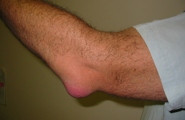 Симптомы бурсита локтевого сустава у взрослых