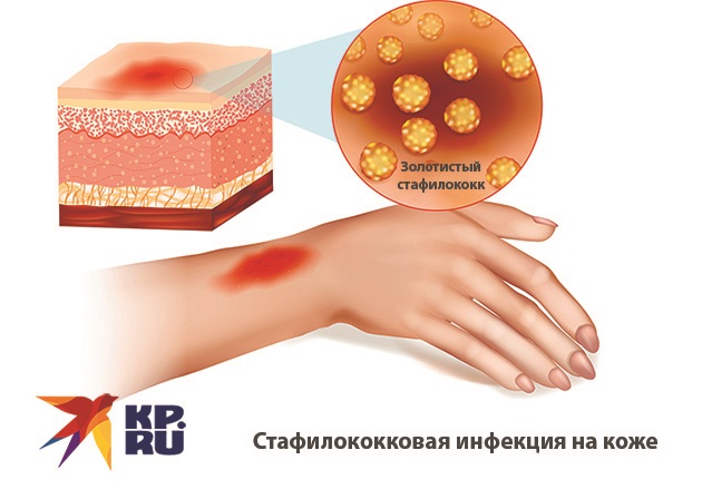 Золотистый стафилококк
