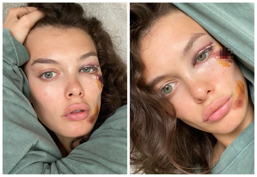 Звезда «Холостяка» изувечила лицо на Бали